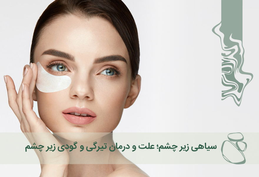 سیاهی زیر چشم؛ علت و درمان تیرگی و گودی زیر چشم